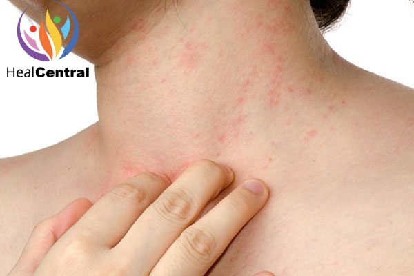 Thuốc HB Digic điều trị mụn nhọt