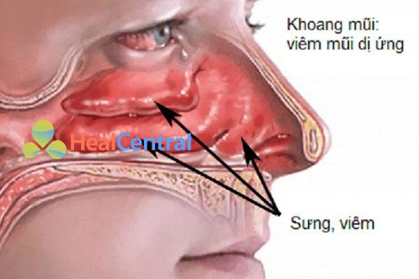 Viêm mũi dị ứng