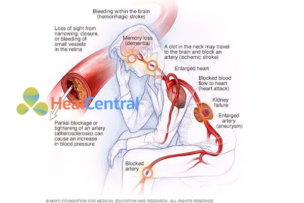 Các biến chứng của bệnh tăng huyết áp