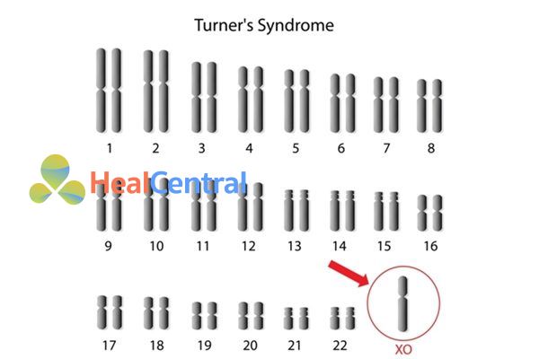 Bộ nhiễm sắc thể của bệnh nhân mất hoàn toàn một nhiễm sắc thể giới tính