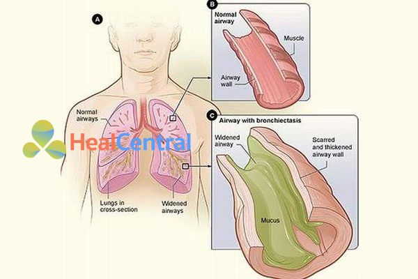 Các bệnh lý có tăng tiết dịch đường hô hấp