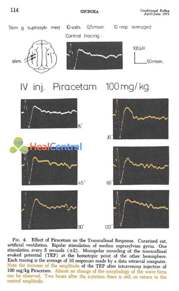 Hiệu quả của piracetam trên đáp ứng thể chai. Liều piracetam 100 mg/kg tĩnh mạch. Chú ý sự gia tăng biên độ của điện thế gợi thể chai sau khi dùng piracetam tại các khoảng thời gian. Hầu như không có sự thay đổi hình thái của dạng sóng. 2 giờ sau tiêm tĩnh mạch nó vẫn không trở về biên độ đối chứng (hình trên cùng).