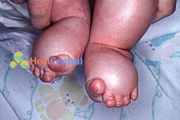 Phù bạch huyết bàn chân ở trẻ sơ sinh. Các ngón chân có hình dạng giống xúc xích đặc trưng.
