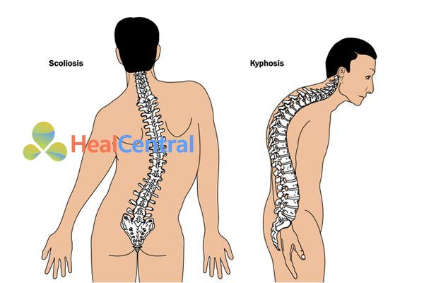 Vẹo và gù cột sống.