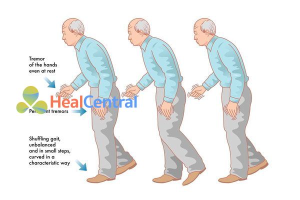 Bệnh Parkinson