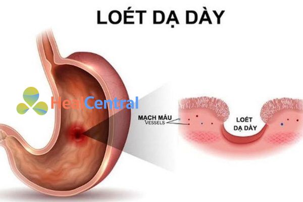 Bệnh loét dạ dày