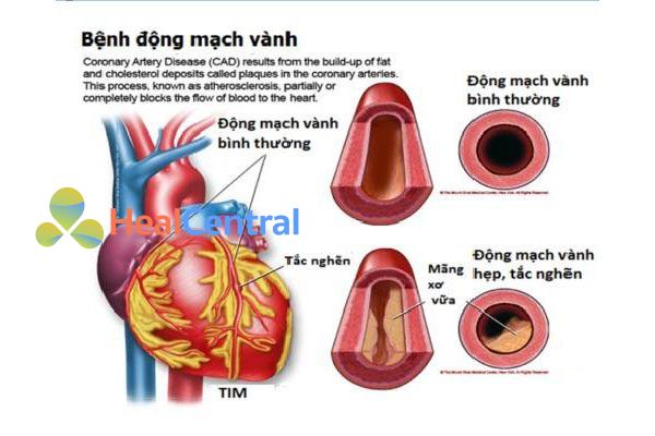 Bệnh mạch vành