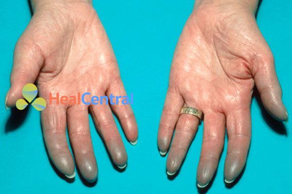 Tay bệnh nhân bị hội chứng Raynaud