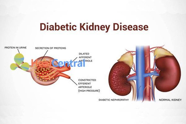 Bệnh thận đái tháo đường