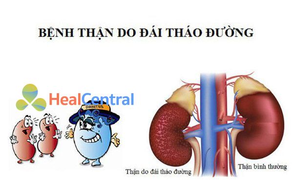 Bệnh thận do đái tháo đường