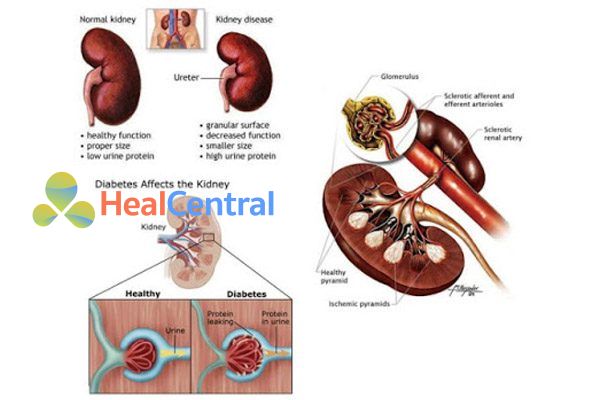 Bệnh thận đái tháo đường