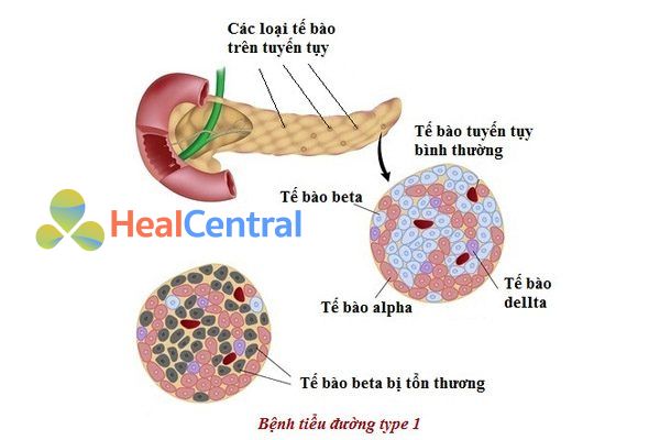 Bệnh đái tháo đường type 1