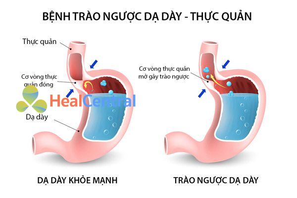 Bệnh trào ngược thực quản dạ dày