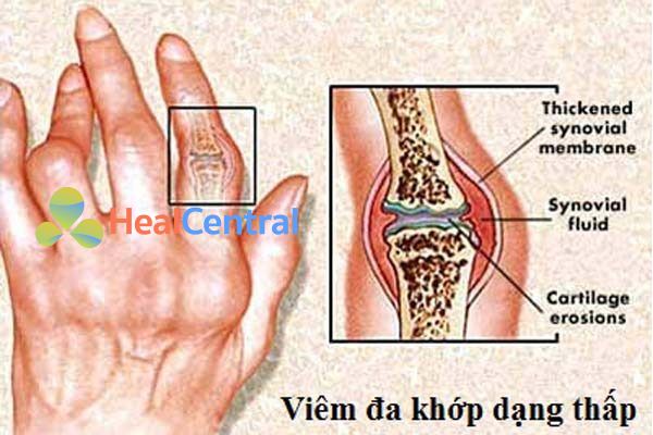 Bệnh viêm khớp dạng thấp