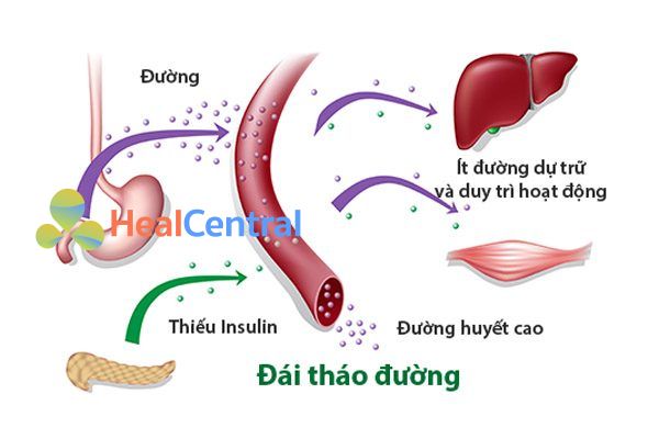 Đái tháo đường