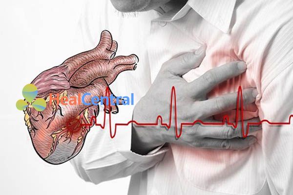 Bệnh đau thắt ngực