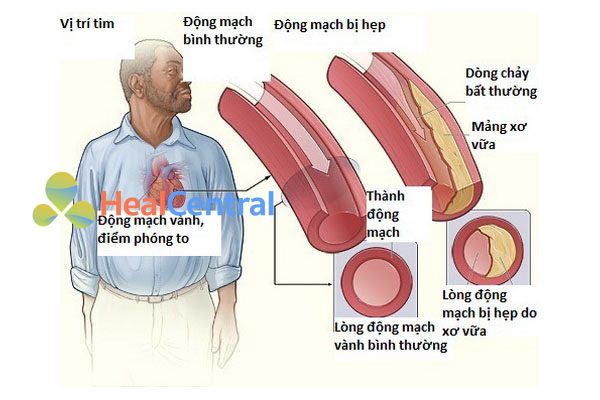 Đau thắt ngực