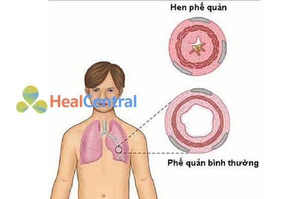 Không dùng natri benzoat với bệnh nhân hen phế quản