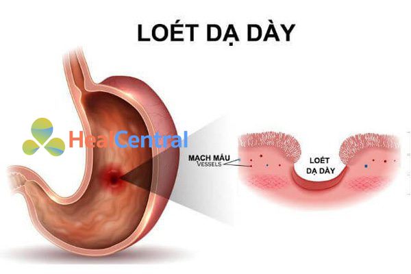 Bệnh loét dạ dày