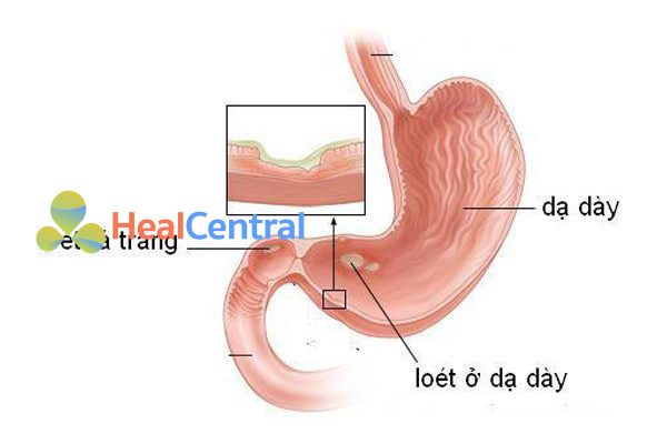 Bệnh loét dạ dày tá tràng