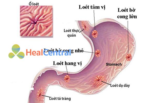 Bệnh loét dạ dày tá tràng