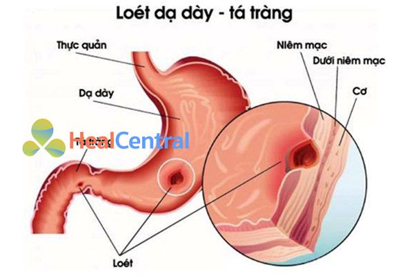 Loét dạ dày