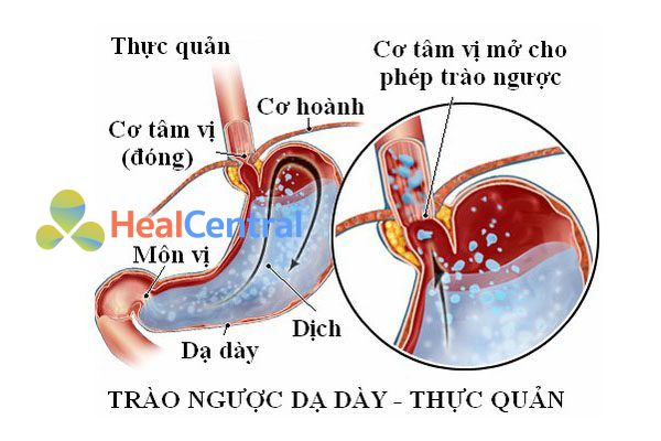 Trào ngược dạ dày thực quản