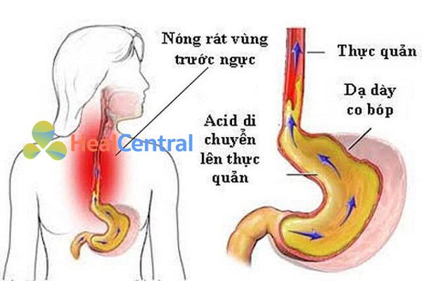 Trào ngược thực quản dạ dày