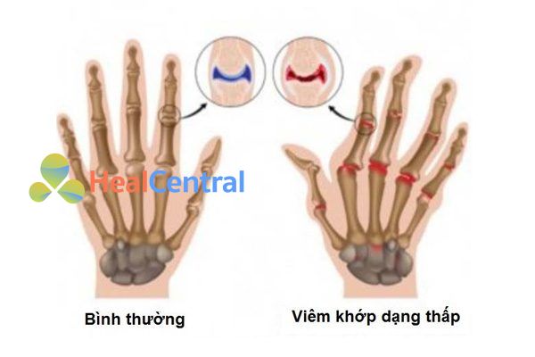 Viêm khớp dạng thấp