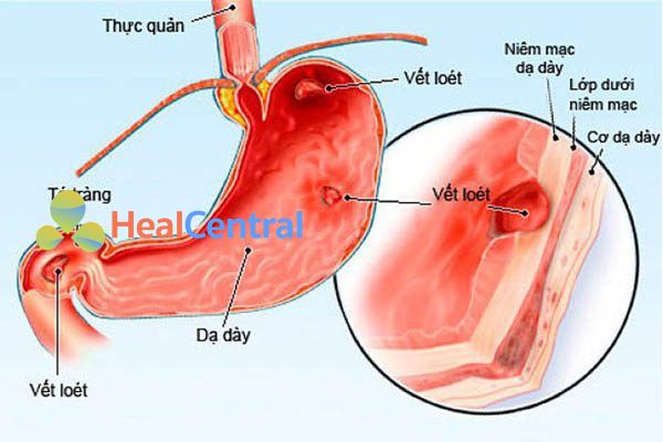 Viêm loét dạ dày tá tràng