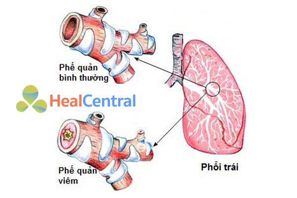 Viêm phế quản