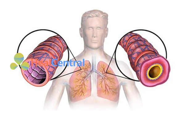 Viêm phế quản co thắt