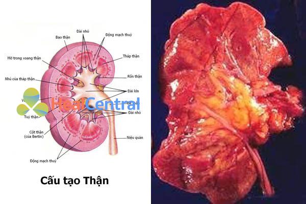 Viêm bể thận