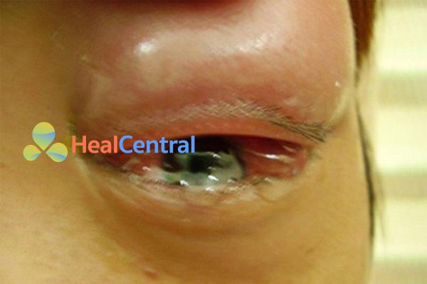 Biến chứng trên mắt của bệnh nhân bị ĐTĐ
