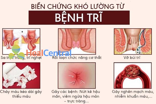  Biến chứng của Trĩ