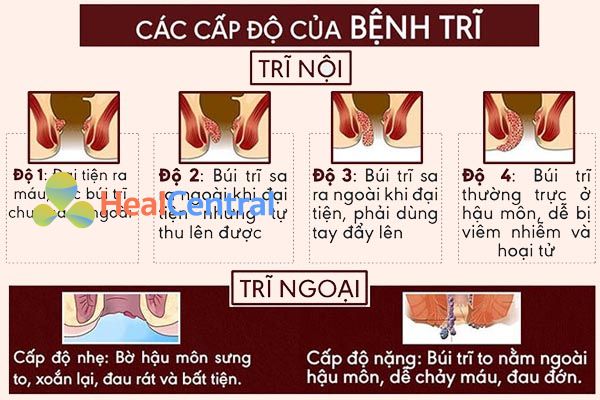 Trĩ nội và hại