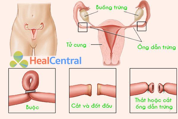 Thắt hoặc cắt ống dẫn trứng ở nữ giới