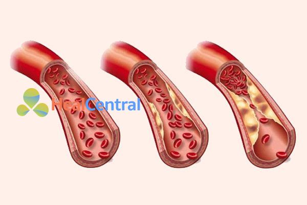 Thuốc Bezafibrate được chỉ định trong các trường hợp rối loạn lipoprotein máu