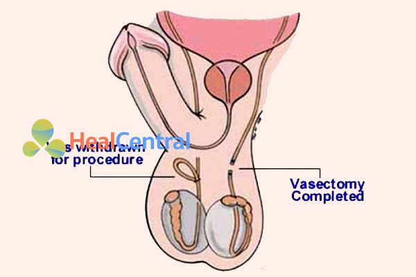 Cắt ống dẫn tinh trùng ở nam giới