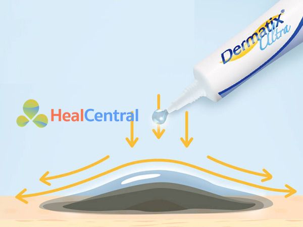 Cách bôi kem trị sẹo Dermatix Ultra