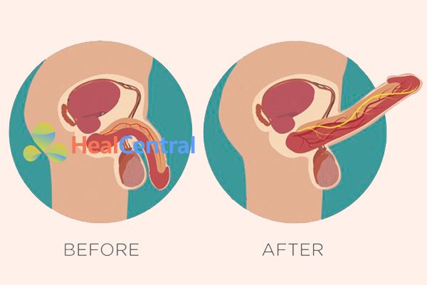 Dương vật trước và sau khi sử dụng thuốc kích dục