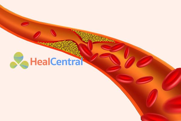 Mỡ máu cao làm tắc nghẽn mạch