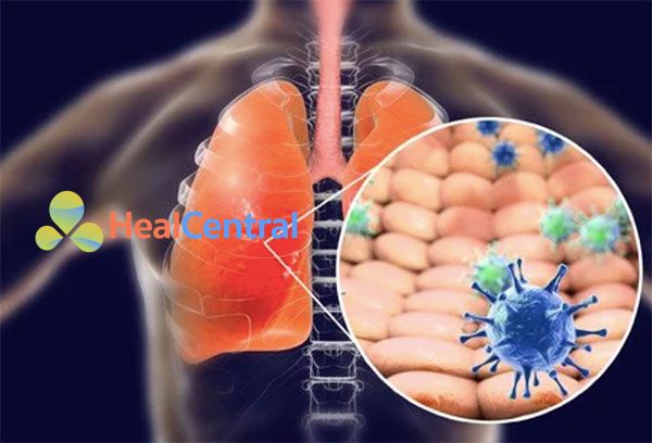 Xử trí suy hô hấp gây ra bởi virus Corona 2019-nCoV mới gây ra 