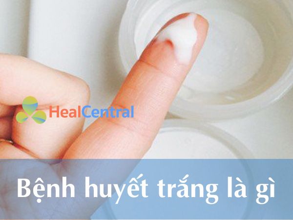 Bệnh huyết trắng là gì?