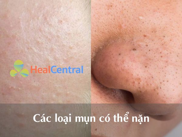 Các loại mụn có thể nặn