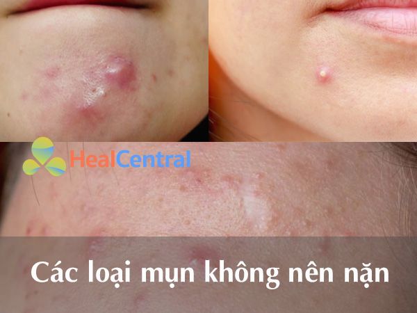 Các loại mụn không nên nặn