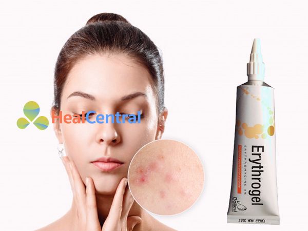 Erythrogel giúp làn da sạch mụn