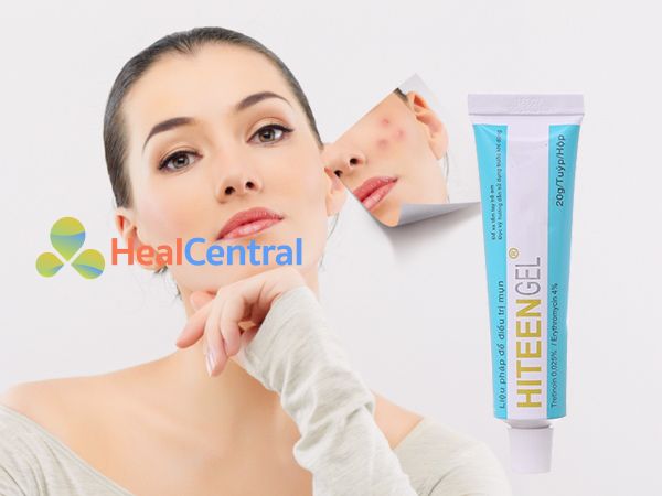 Kem trị mụn Hiteen gel giúp làn da sạch mụn