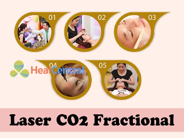 Công nghệ mới Laser CO2 Fractional mang lại hiệu quả cao, không đau đơn, không để lại sẹo