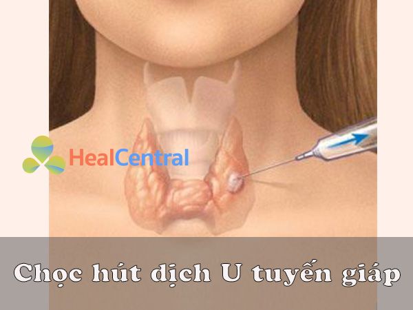 Chọc hút dịch U tuyến giáp